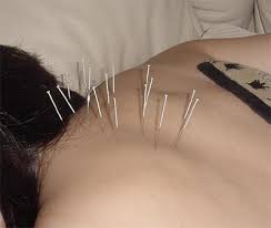 acupuncture 236